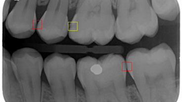 Dentists could soon have a new AI co-pilot to detect tooth decay