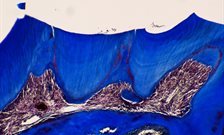 Natural tooth repair method discovered by King's College London can also be used on common cavities, protecting teeth from further damage