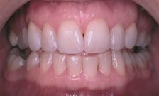 Natural tooth repair method, using Alzheimer's drug, could revolutionise dental treatments