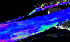 A novel RARb agonist for spinal cord injury receives funding for a phase 1 trial from the MRC-DPFS