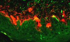 Researchers uncover the source of diabetic pain