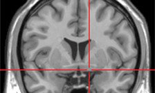 Standard brain scans could predict cognitive decline in Parkinson's