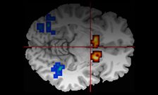 Cannabis extract helps reset brain function in psychosis