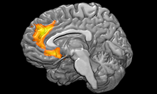 Brain volume drops in patients with PTSD