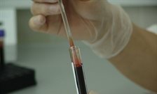 Researchers discover potential 'early warning markers' for sepsis
