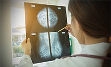 Identifying lymph-node positive breast cancer patients