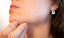 'World first' acne study uncovers hope for new treatment