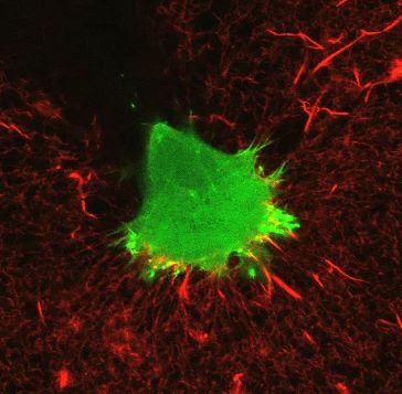 ParsonsGrp_invading breast cancer cell