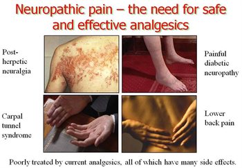 Neuropathic-pain