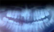 CachedImageteeth