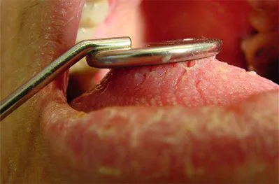 mucosal-oral-dry