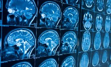 brain