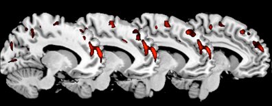 anterior rostral