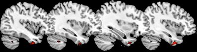 anterior temporal cortex