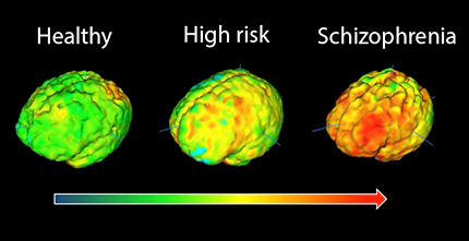 schizophrenia-brain-inarticle