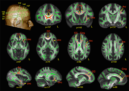autism-brain-diffs