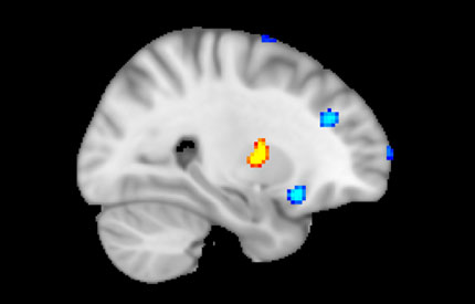 Computers-can-spot the difference-between-healthy-brains-430x275