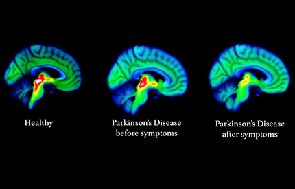 Study-reveals-roots-of-Parkinsons-in-the-brain-430x275