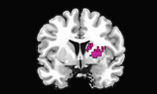 Katya Rubia - ADHD Brain scan