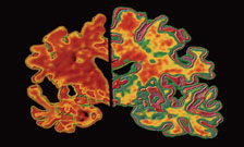 Alzheimers-brain