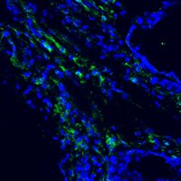 Macrophages (green) in breast cancer