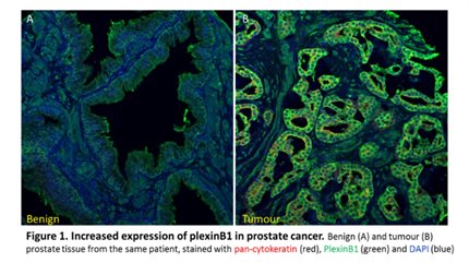 Prostate Cancer Research Centre Metastasis Group