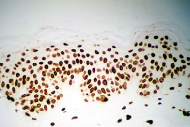 Human skin stained for DNA damage after repeated low dose solar simulated radiation.