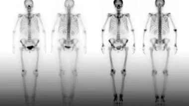 OsteoPuff454x276