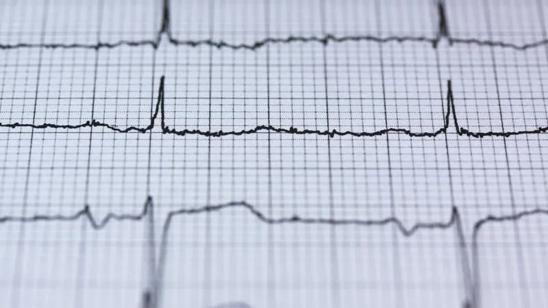 ECG Printout