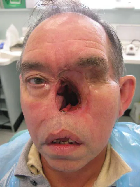 Patient-after-3-months-of-surgical-removal-of-a-Squamous-cell-carcinoma-SCC-involving-loss-of-eye-nose-and-part-of-the-cheek