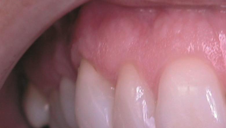 Teeth hold the key to early diagnosis of eating disorders - King's College  London