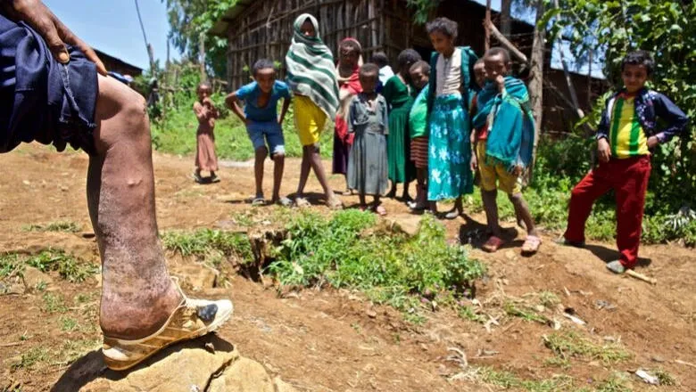 A man with podoconiosis in a village in the Amhara region, Ethiopia. Image by Dr Alex Kumar, www.alexanderkumar.com 