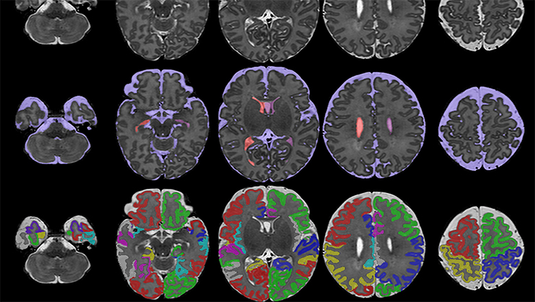 New Study Adds Key Piece To Autism >> New Study Could Help Predict Symptoms Of Autism And Adhd At New Study Adds Key Piece To Autism >> New Study Could Help Predict Symptoms Of Autism And Adhd At