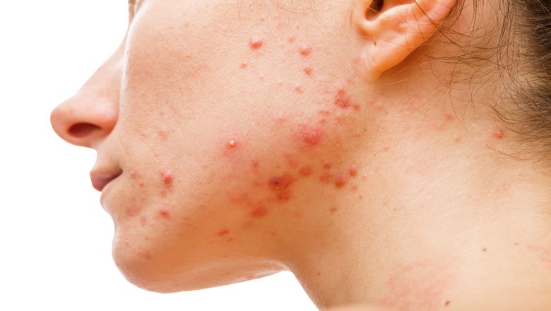 These are the reasons why you may have a predisposition for acne scarring