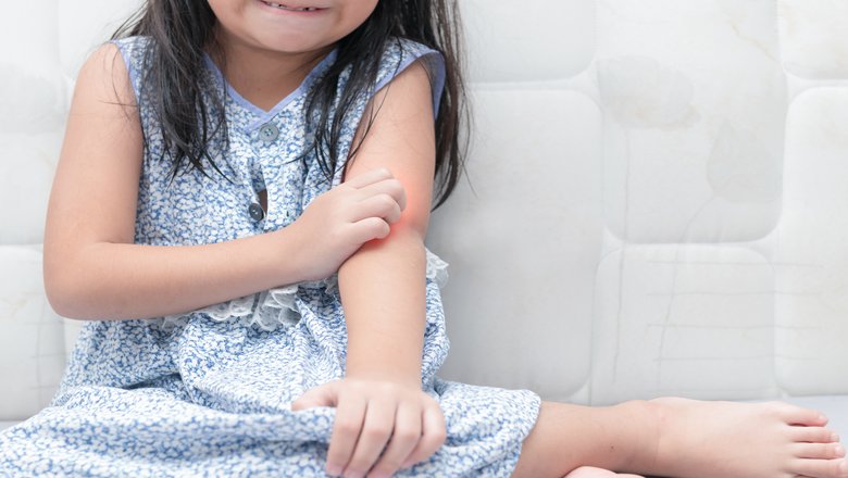 A common skin bacterium put children with severe eczema at higher risk of food allergy image