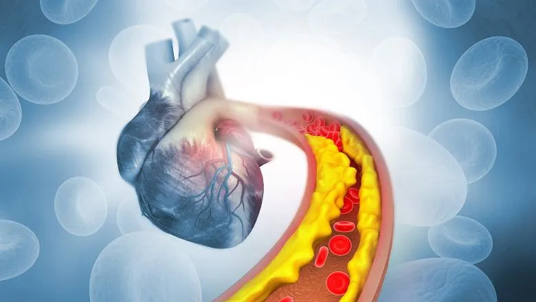 Unhealthy cholesterol linked to long COVID