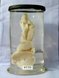 Hodgkin specimen