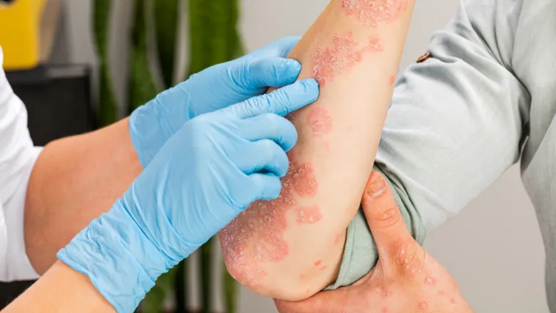 A dermatologist wearing gloves examines the skin of a sick patient. 