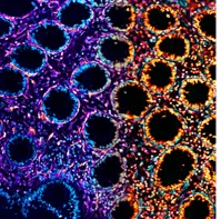 A section of the intestinal wall from a patient with Crohn’s disease, showing circular crypts surrounded by mesenchymal cells. The image is pseudocolored to show how ILC1 could mediate wound healing, but that this could tip towards cancer or fibrosis if the response is uncontrolled.