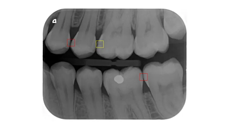 Photo showing AI-assisted detection of early interproximal caries on a 'bitewing' X-ray