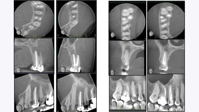 apical periodontitis and cardiovascular disease