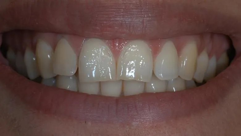 Teeth with erosive tooth wear