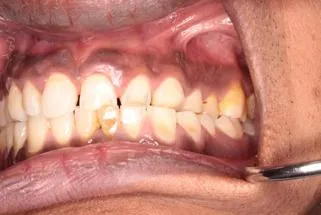 Risk factors for ETW in patients with gastro-oesophageal Reflux Disease (GORD) and the role of saliva and pellicle