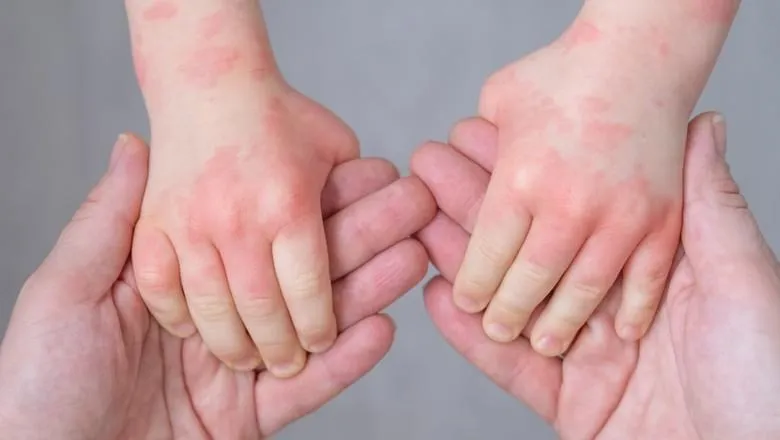 A close up of kid's hand with allergic rash or eczema