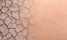 Skin conditions