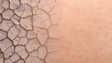 Skin conditions