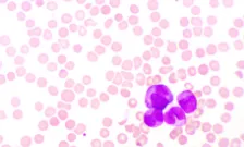 acute myeloid leukemia samples