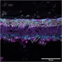 Gene therapy for inherited retinal dystrophy