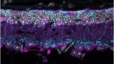 Gene therapy for inherited retinal dystrophy