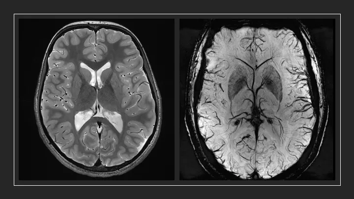 7T Brain scans